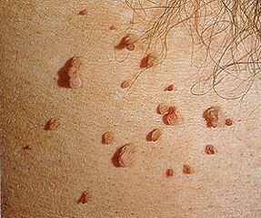 virus do papiloma humano na pel